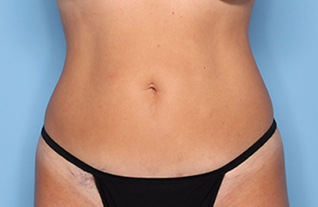 Case--22724 | After Mini Abdominoplasty