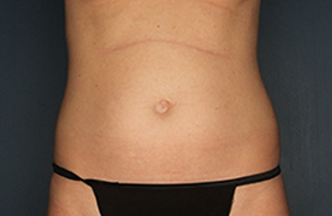 Case--22824 | Before Mini Abdominoplasty