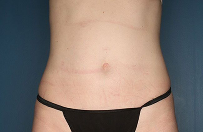 Case--22824 | After Mini Abdominoplasty