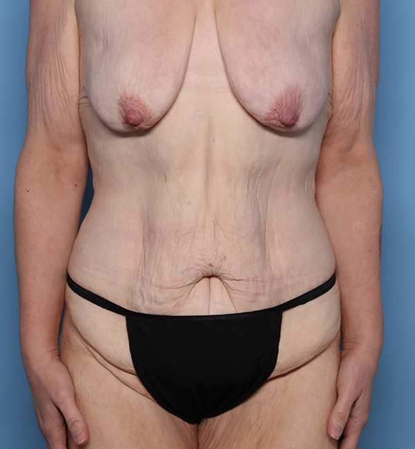 Case--23224 | Before Abdominoplasty after Massive Weight Loss