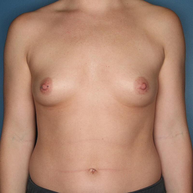 Case--2324 | Before Cosmetic Breast Surgery