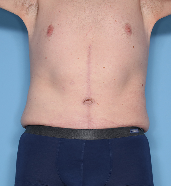 Case--23324 | After Abdominoplasty after Massive Weight Loss