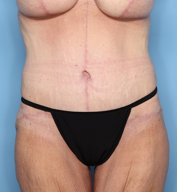 Case--23424 | After Abdominoplasty after Massive Weight Loss