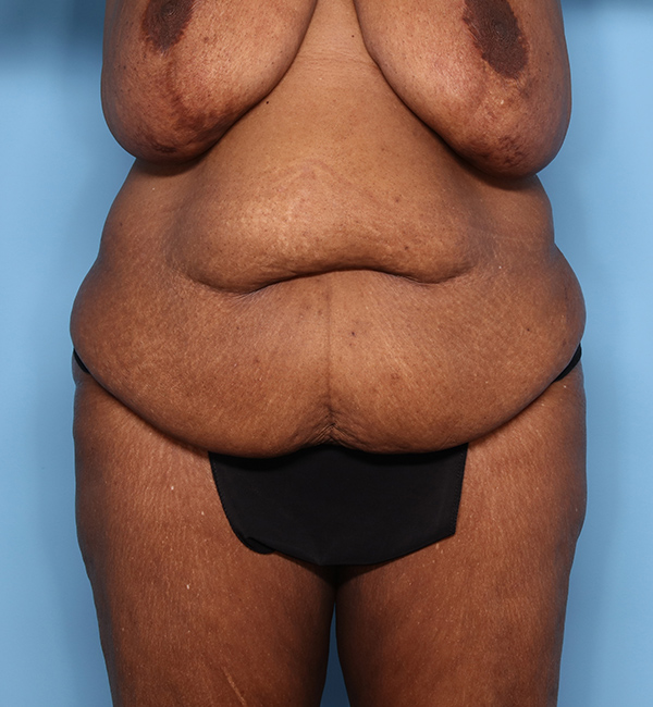 Case--23524 | Before Abdominoplasty after Massive Weight Loss