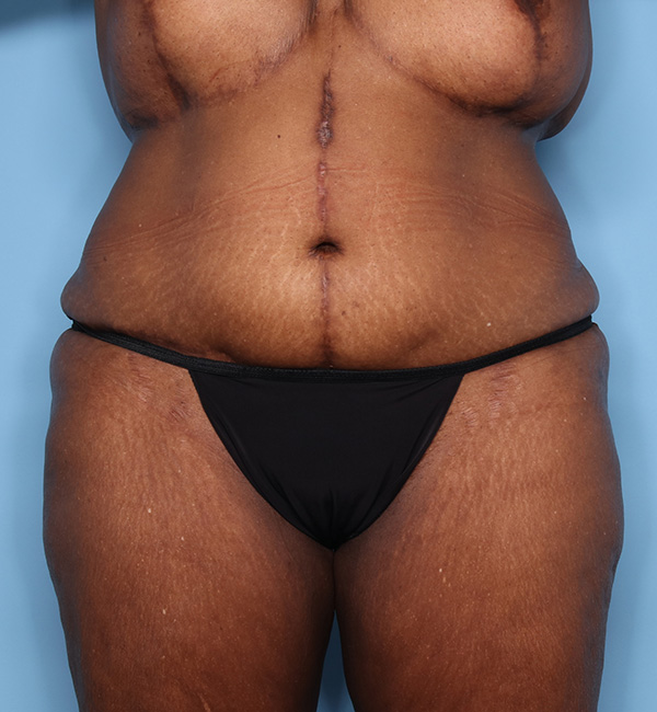 Case--23524 | After Abdominoplasty after Massive Weight Loss