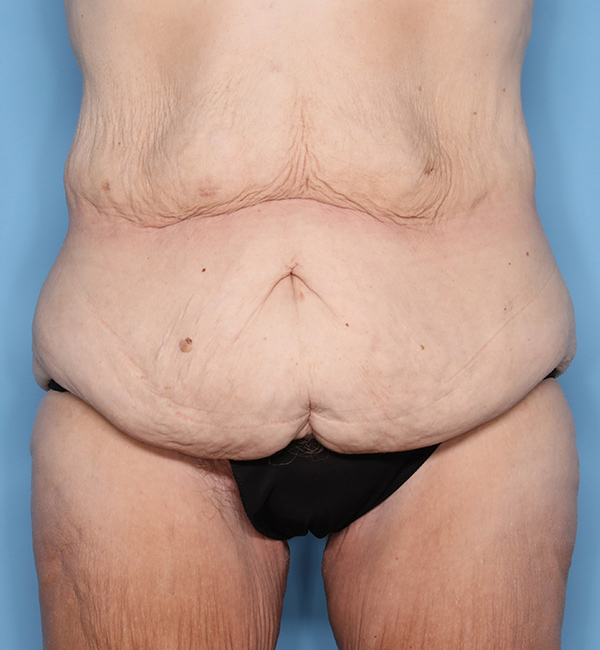Case--23724 | Before Abdominoplasty after Massive Weight Loss