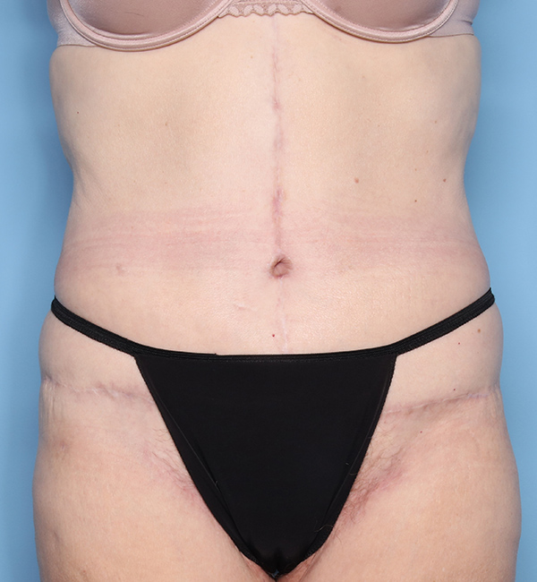 Case--23724 | After Abdominoplasty after Massive Weight Loss