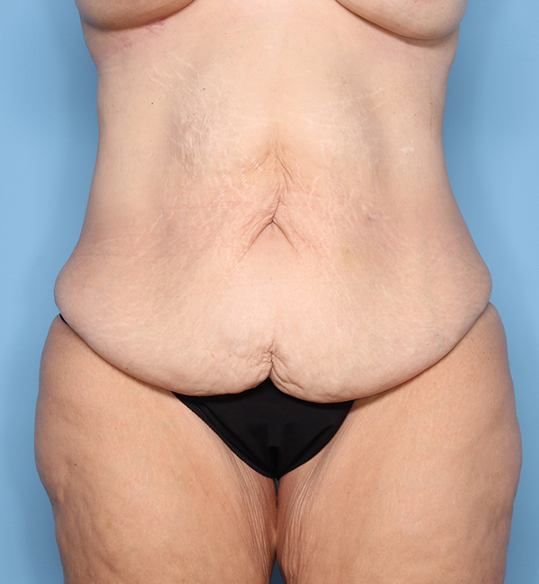 Case--23824 | Before Abdominoplasty after Massive Weight Loss