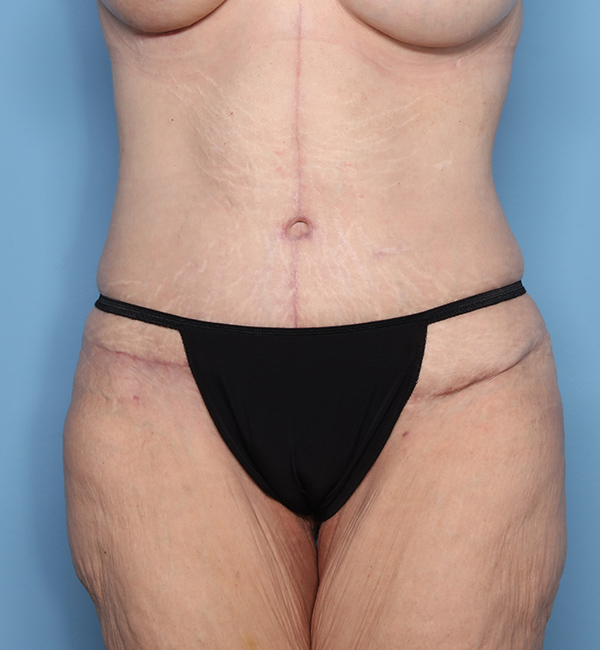 Case--23824 | After Abdominoplasty after Massive Weight Loss