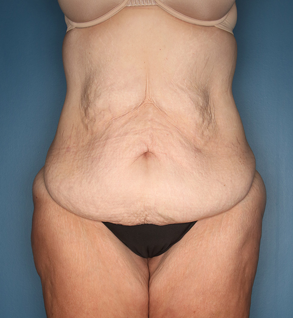 Case--23924 | Before Abdominoplasty after Massive Weight Loss