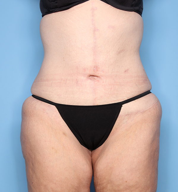 Case--23924 | After Abdominoplasty after Massive Weight Loss