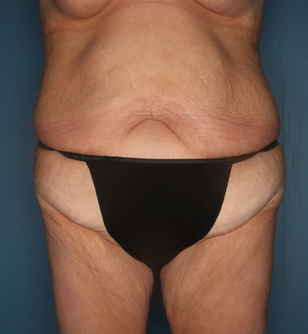 Case--24024 | Before Abdominoplasty after Massive Weight Loss