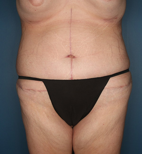 Case--24024 | After Abdominoplasty after Massive Weight Loss