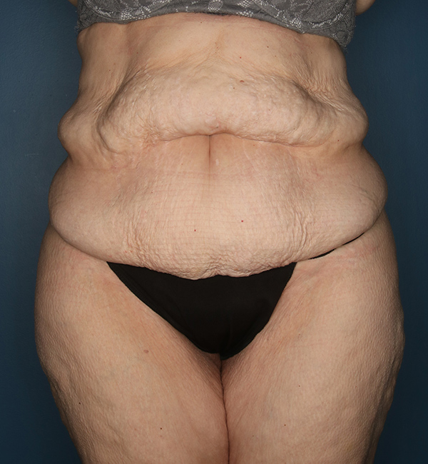 Case--24224 | Before Abdominoplasty after Massive Weight Loss