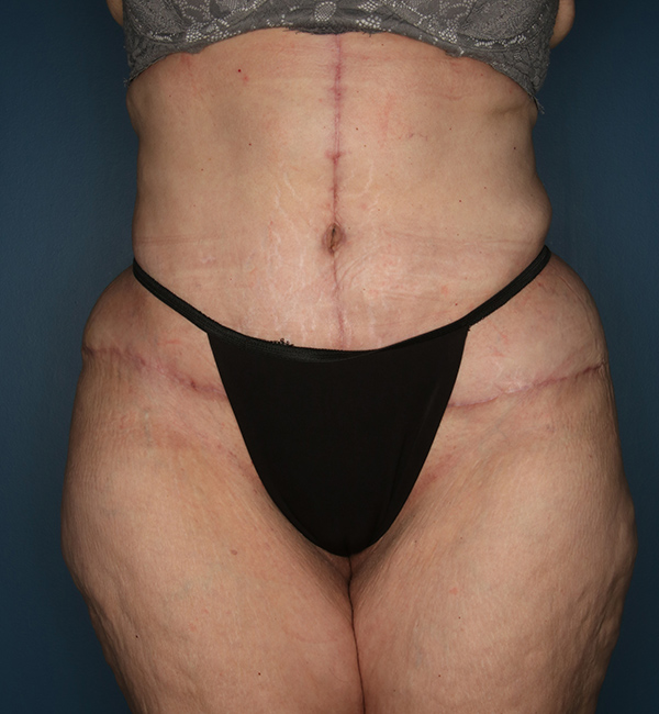 Case--24224 | After Abdominoplasty after Massive Weight Loss