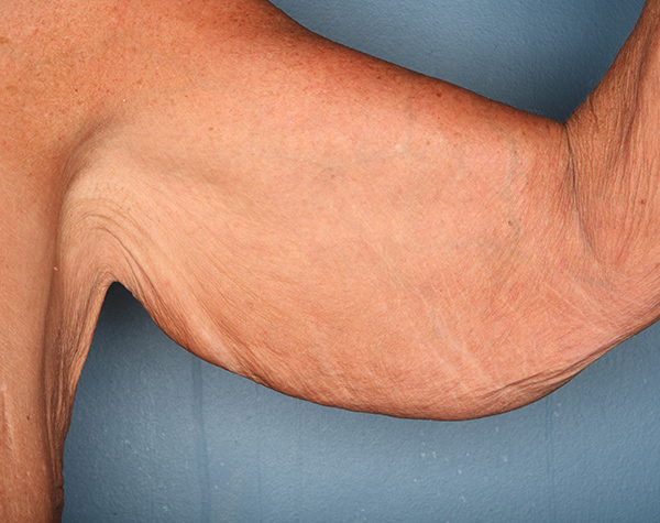 Case--24324 | Before Brachioplasty