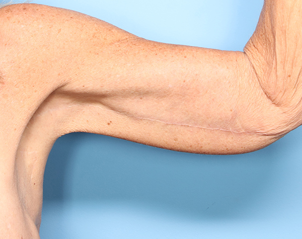 Case--24324 | After Brachioplasty