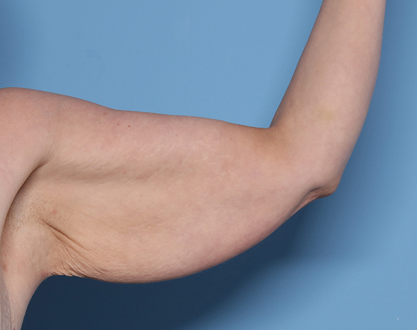 Case--24424 | Before Brachioplasty