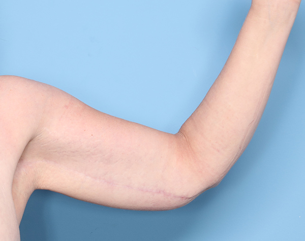 Case--24424 | After Brachioplasty