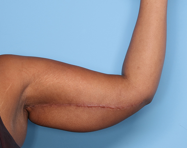 Case--24524 | After Brachioplasty