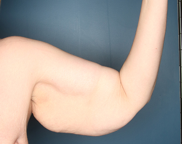 Case--24624 | Before Brachioplasty