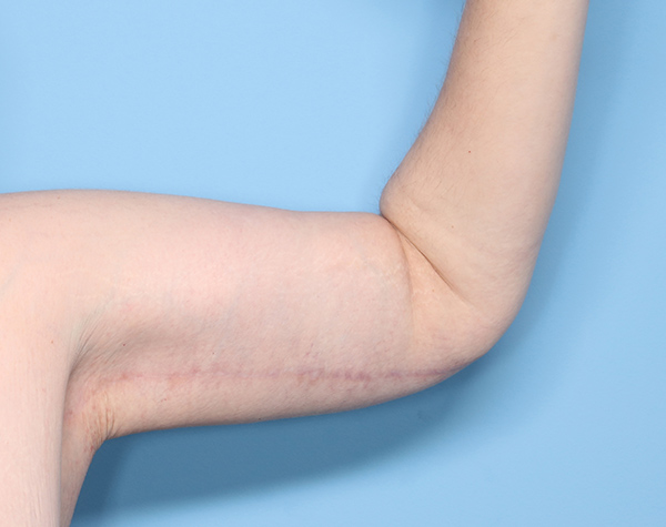 Case--24624 | After Brachioplasty