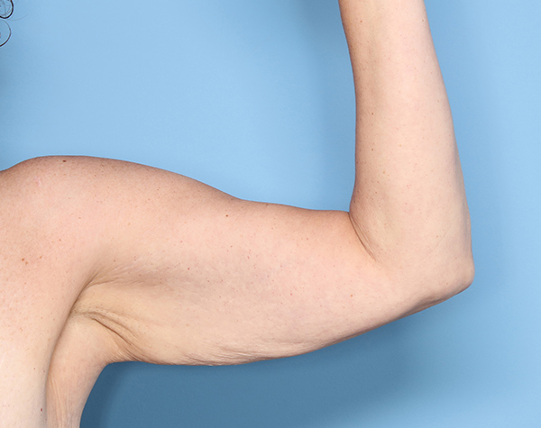 Case--24724 | Before Brachioplasty