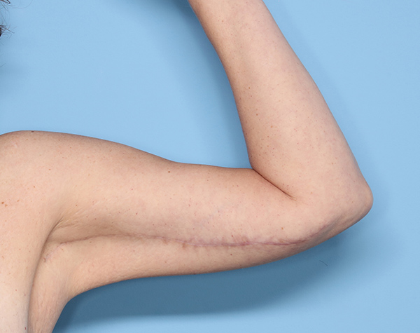 Case--24724 | After Brachioplasty