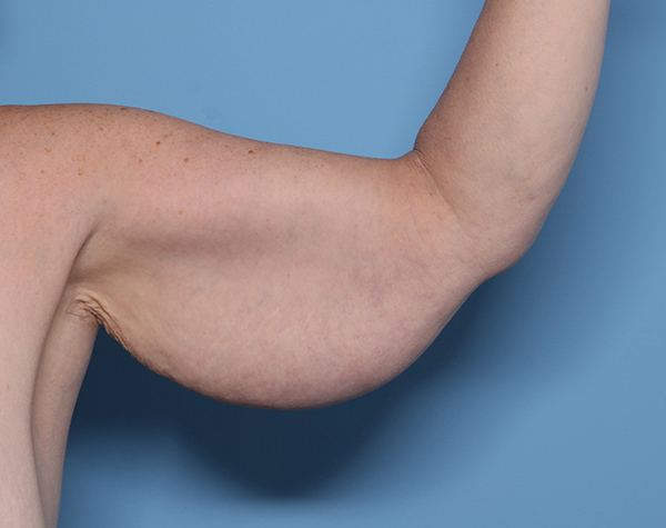 Case--24824 | Before Brachioplasty