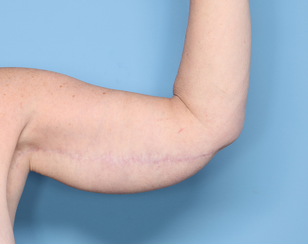 Case--24824 | After Brachioplasty