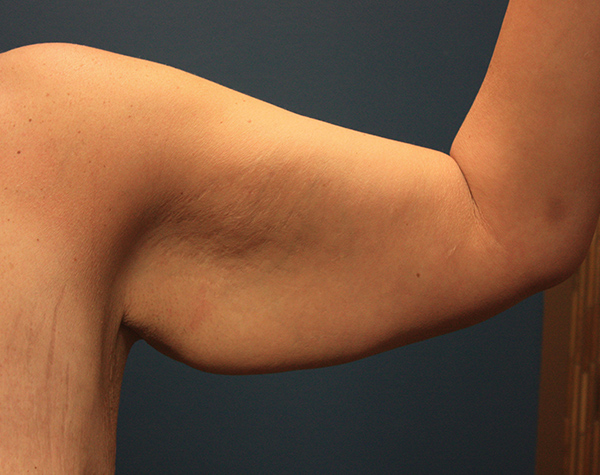 Case--24924 | Before Brachioplasty