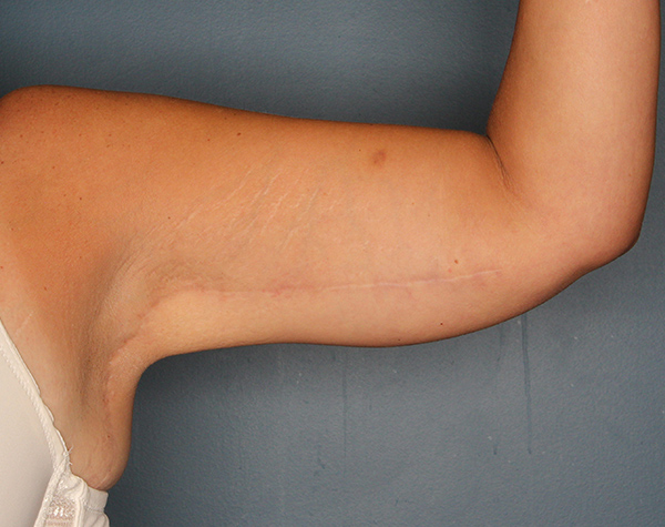 Case--24924 | After Brachioplasty