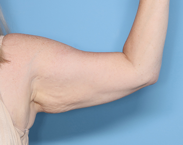 Case--25024 | Before Brachioplasty