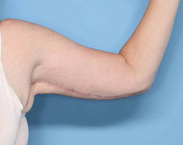 Case--25024 | After Brachioplasty