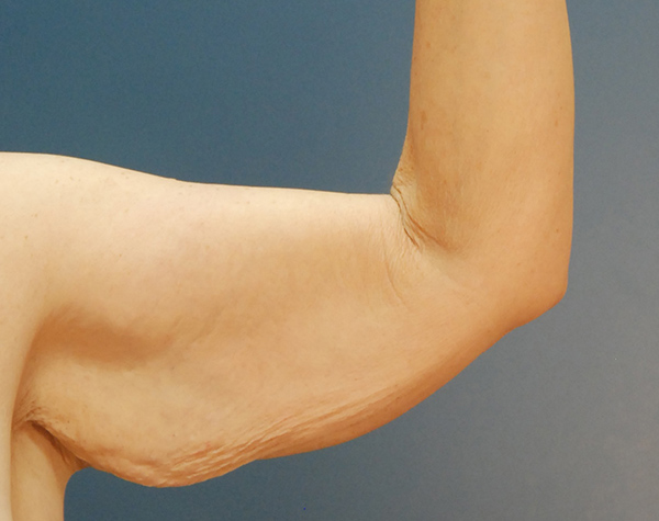 Case--25124 | Before Brachioplasty