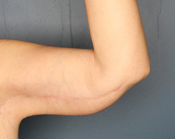 Case--25124 | After Brachioplasty