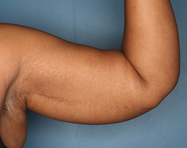 Case--25224 | After Brachioplasty