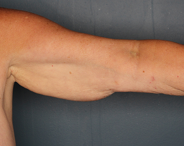Case--25324 | Before Brachioplasty
