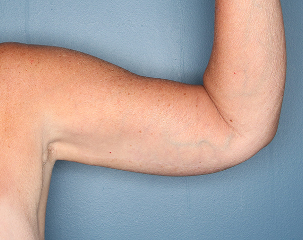 Case--25324 | After Brachioplasty