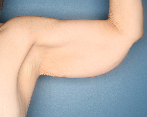Case--25424 | Before Brachioplasty