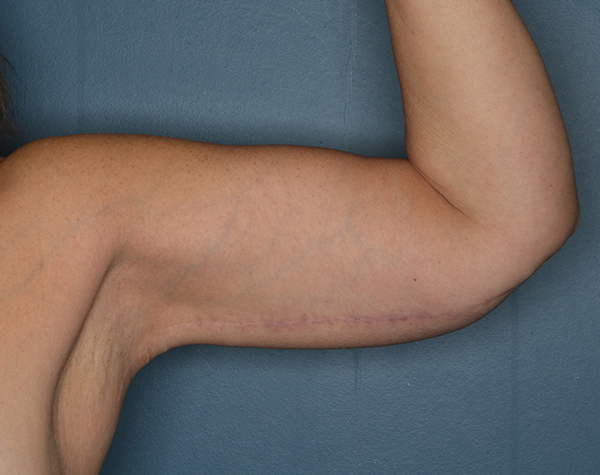 Case--25424 | After Brachioplasty
