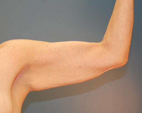 Case--25524 | Before Brachioplasty