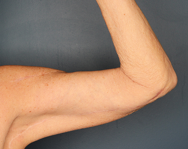 Case--25524 | After Brachioplasty