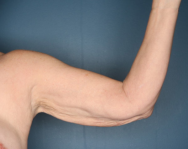 Case--25624 | Before Brachioplasty