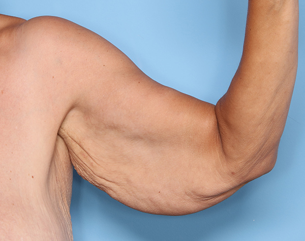 Case--25724 | Before Brachioplasty