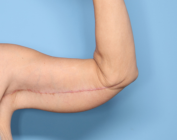 Case--25724 | After Brachioplasty