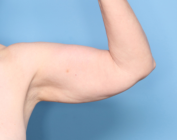 Case--25824 | Before Brachioplasty