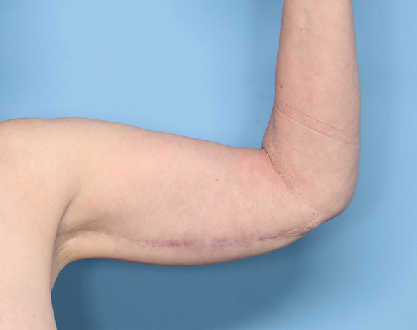 Case--25824 | After Brachioplasty