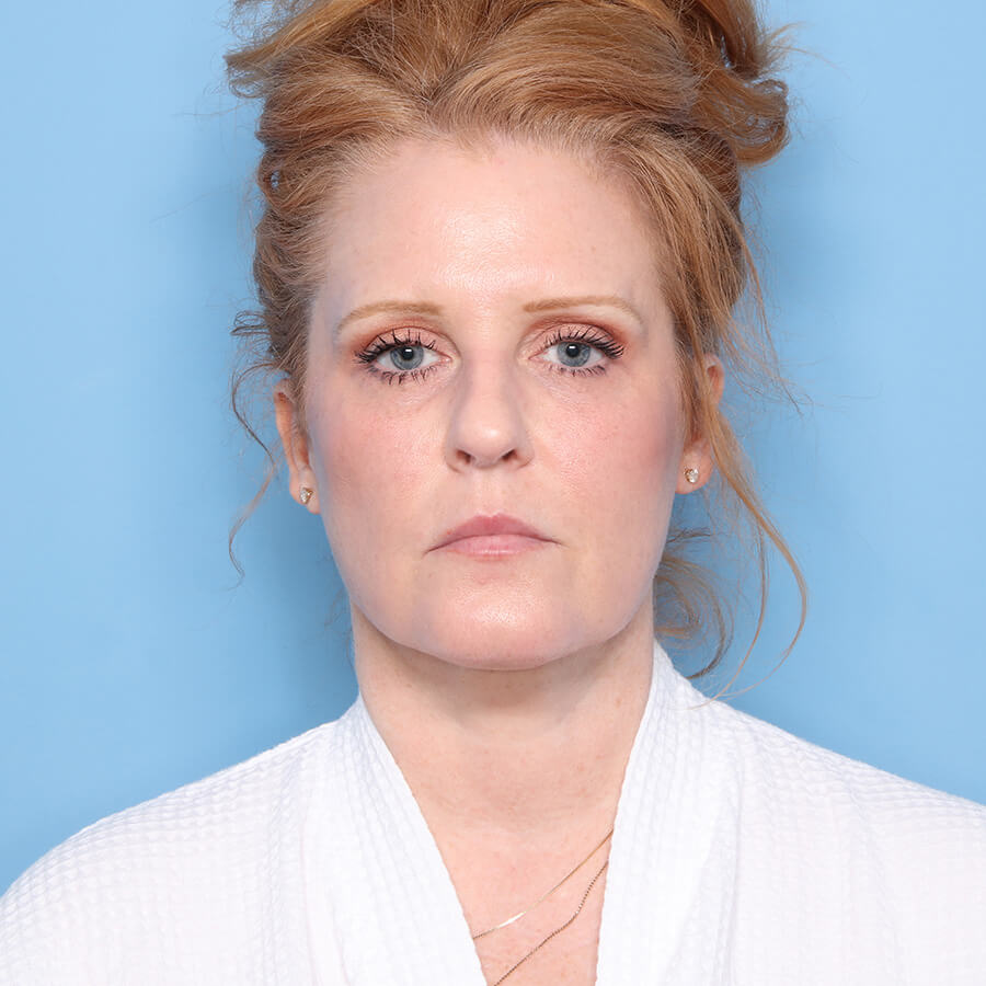 Case--25924 | After Neck Lift