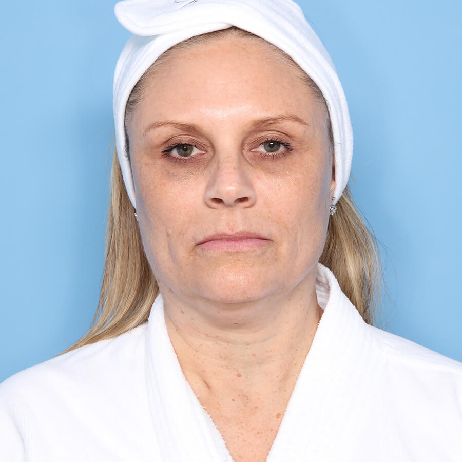 Case--26024 | Before Neck Lift